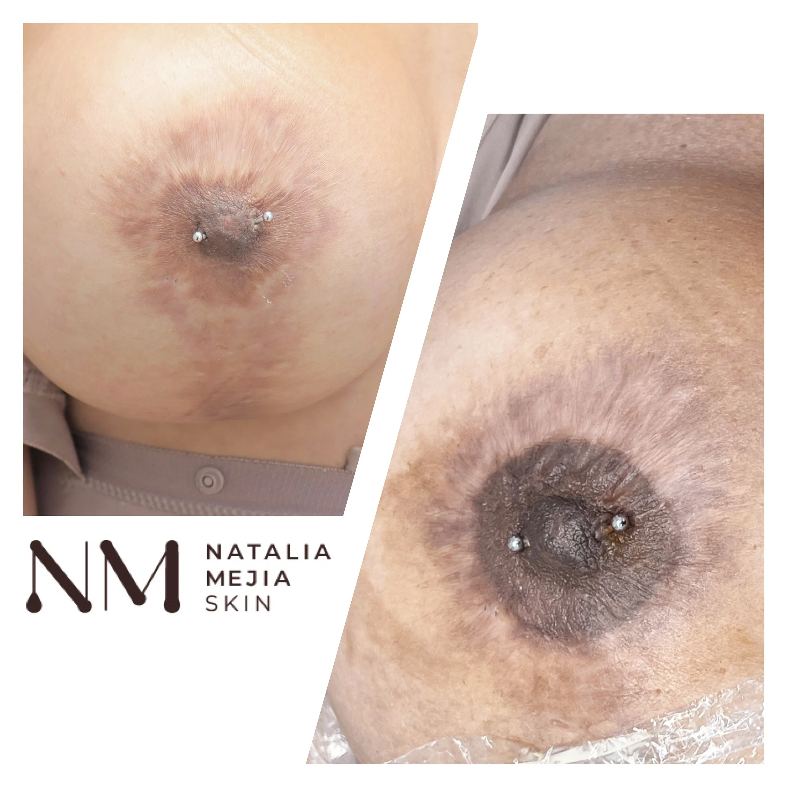 nipple plastic surgery