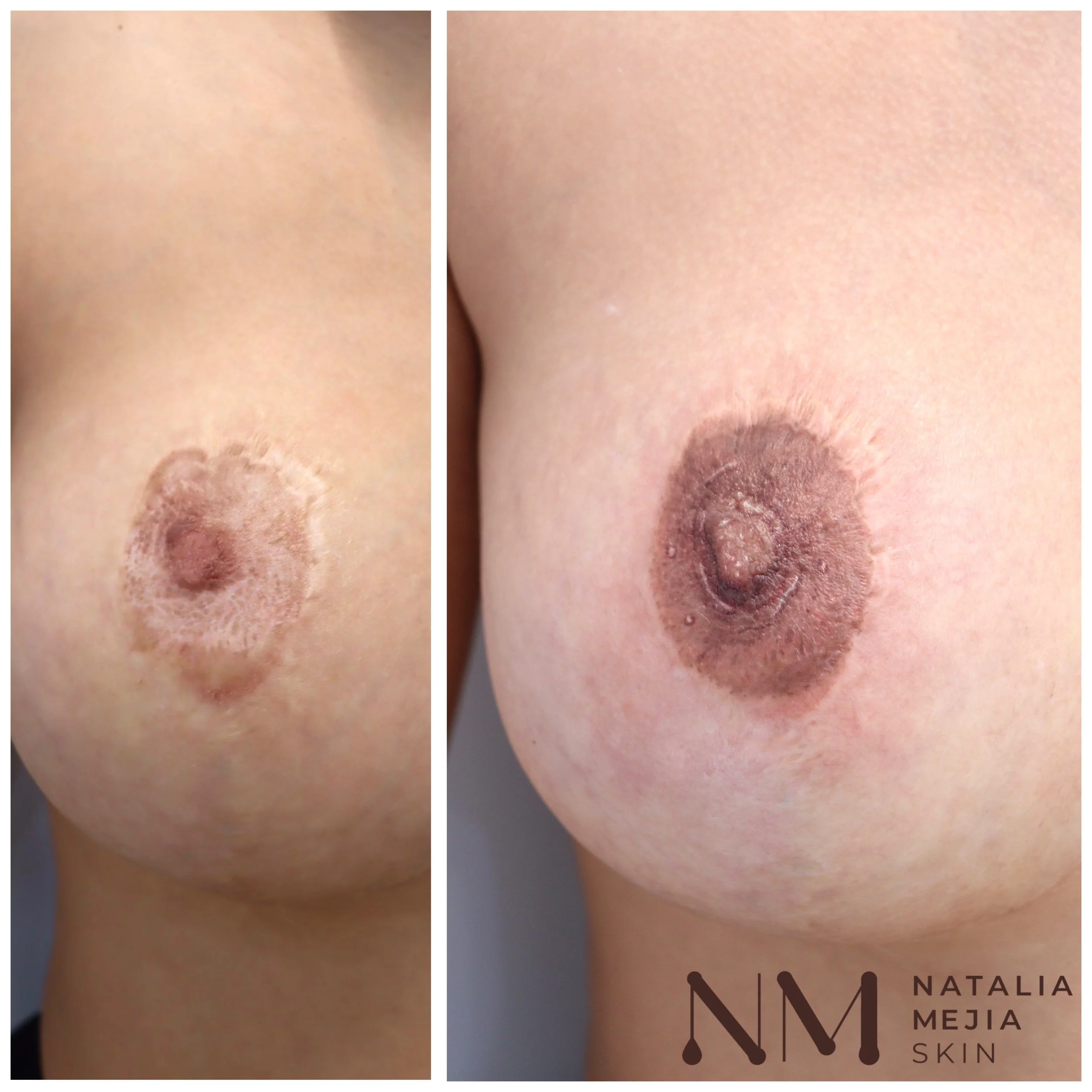 nipple plastic surgery