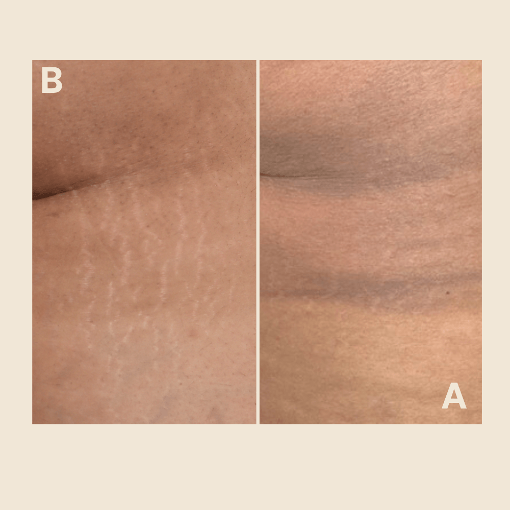 Stretch Marks regeneration