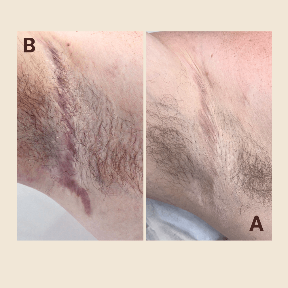 scar revision - other scars