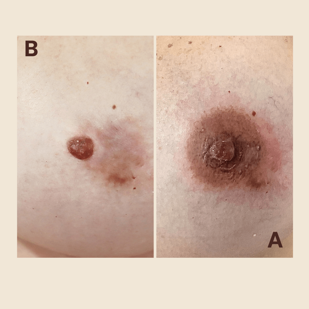 Cancer Breast - 3d Areola tattoo