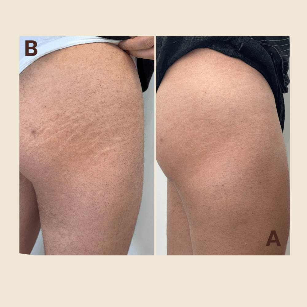 Regeneration Stretch Marks