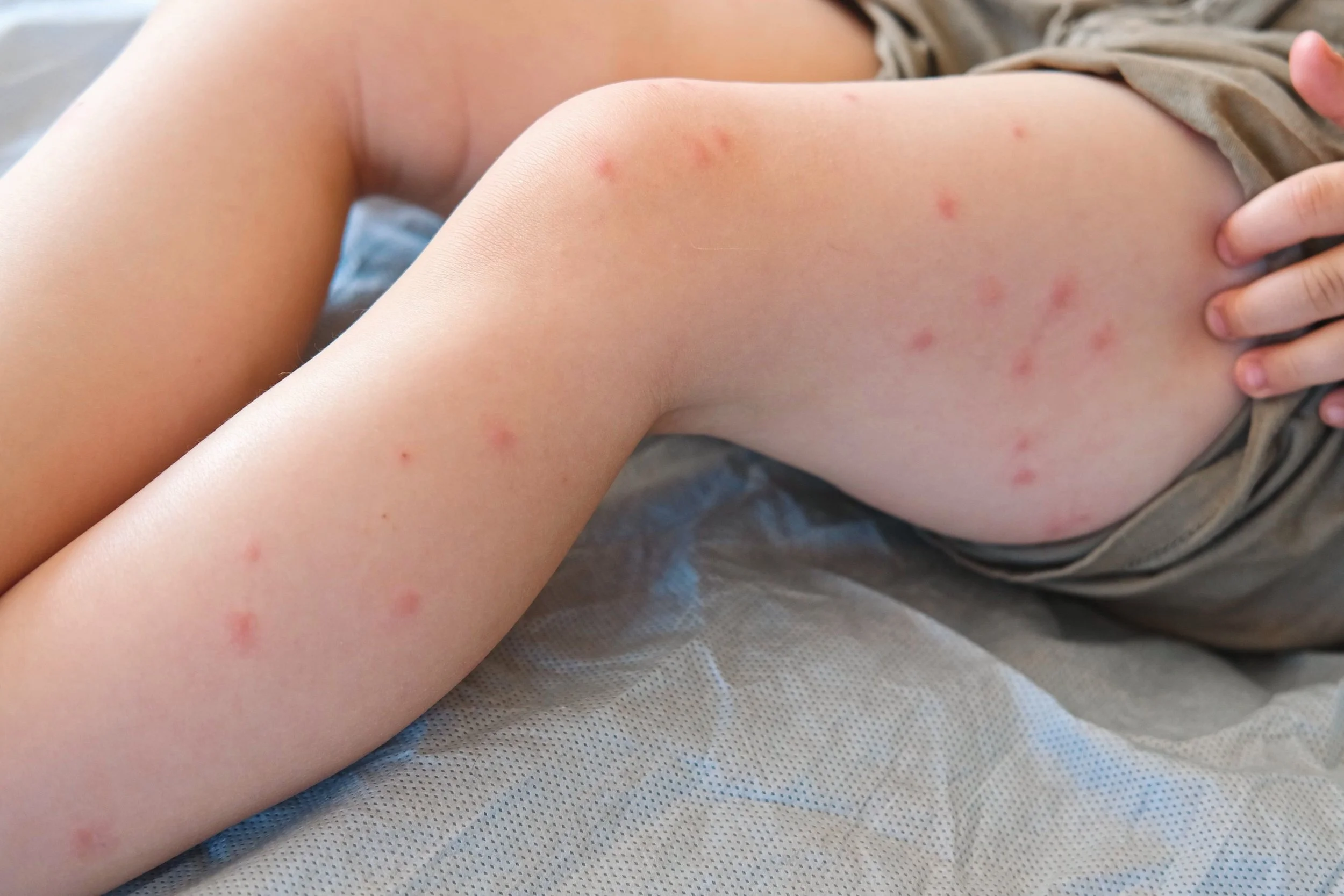 ปฏิกิริยาแมลงกัดต่อย (ผื่นแพ้ยุงมดแมลง)