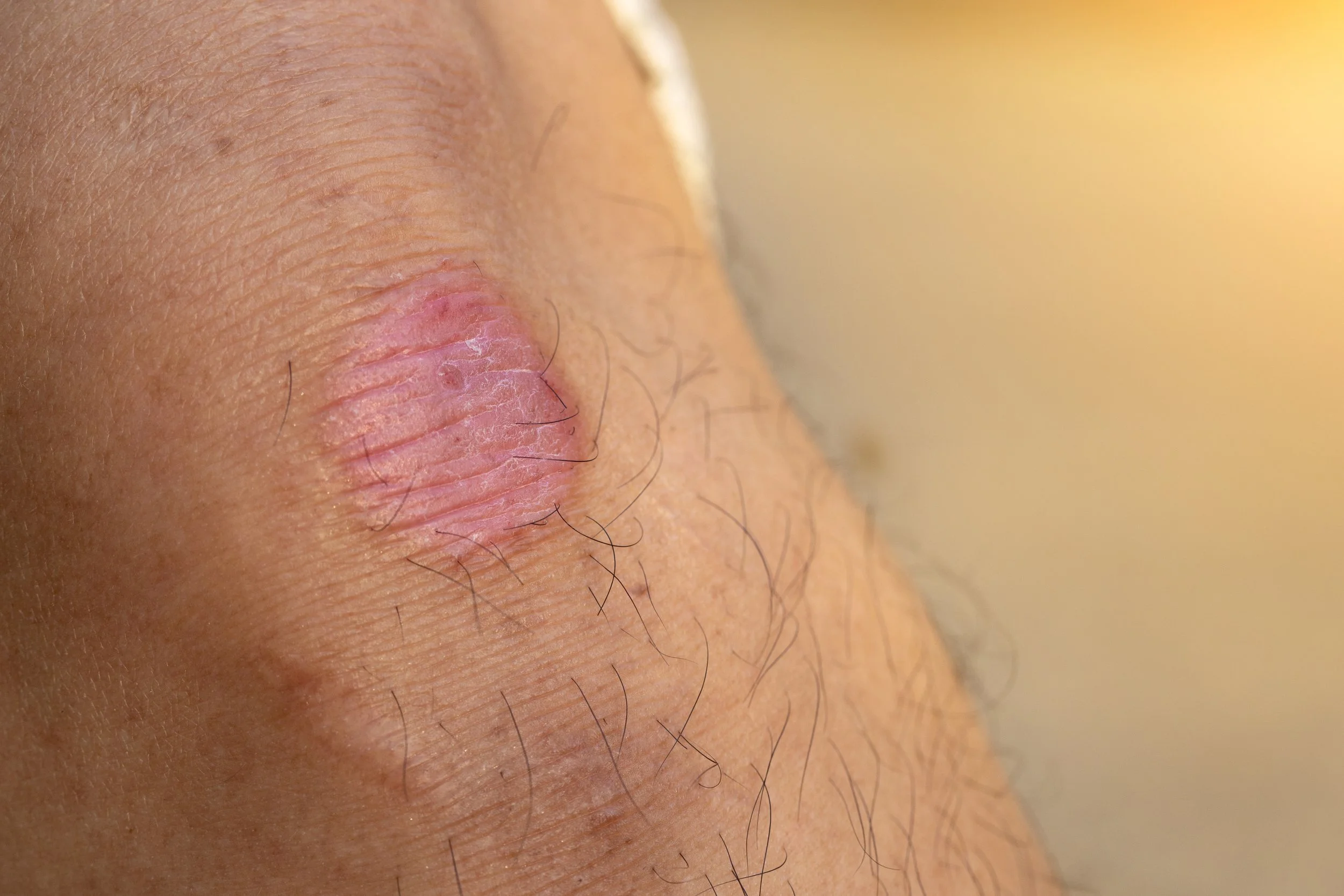 การรักษาไฟลามทุ่งErysipelasและการติดเชื้อแบคทีเรียCellulitis