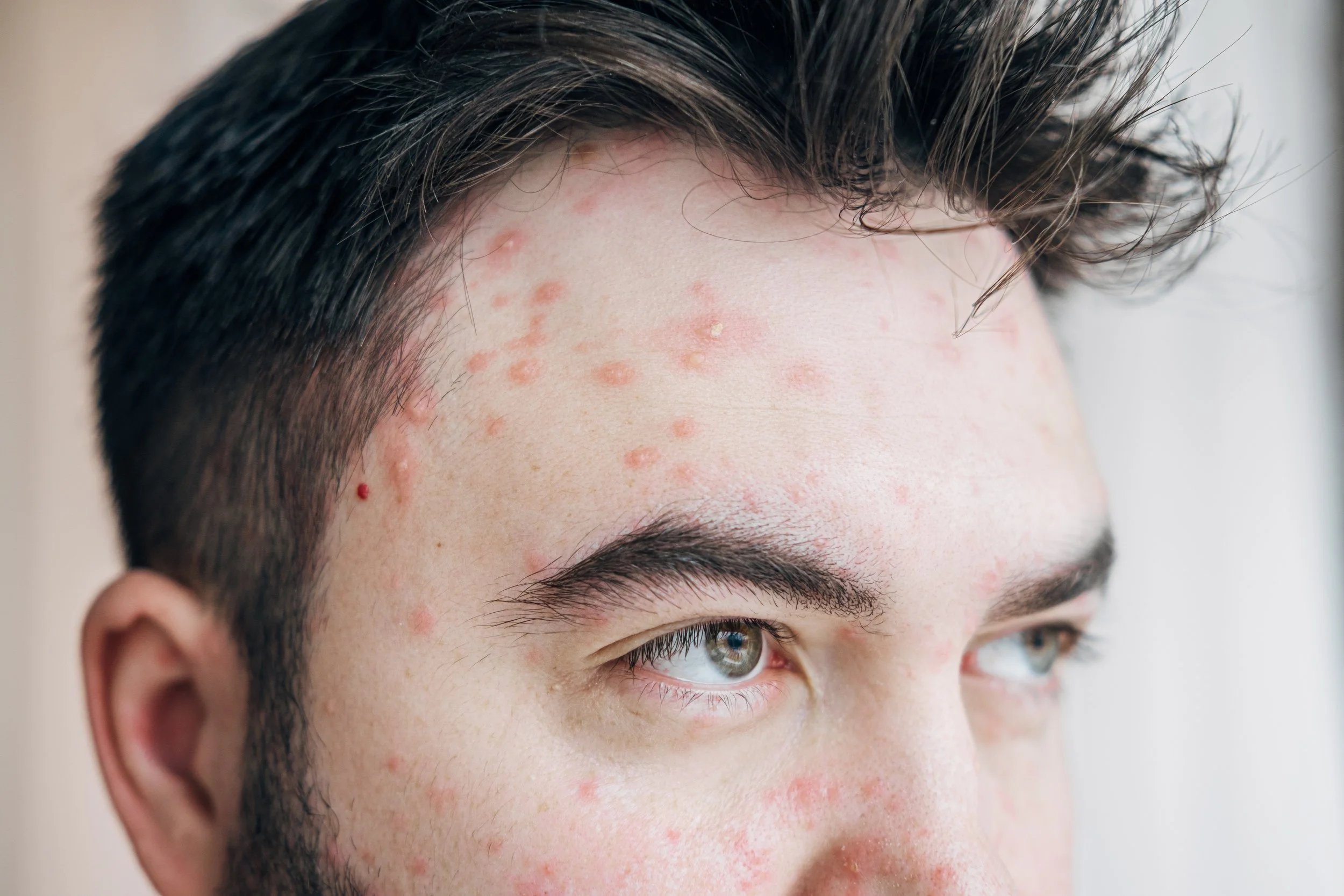 Herpes Zoster (งูสวัด)