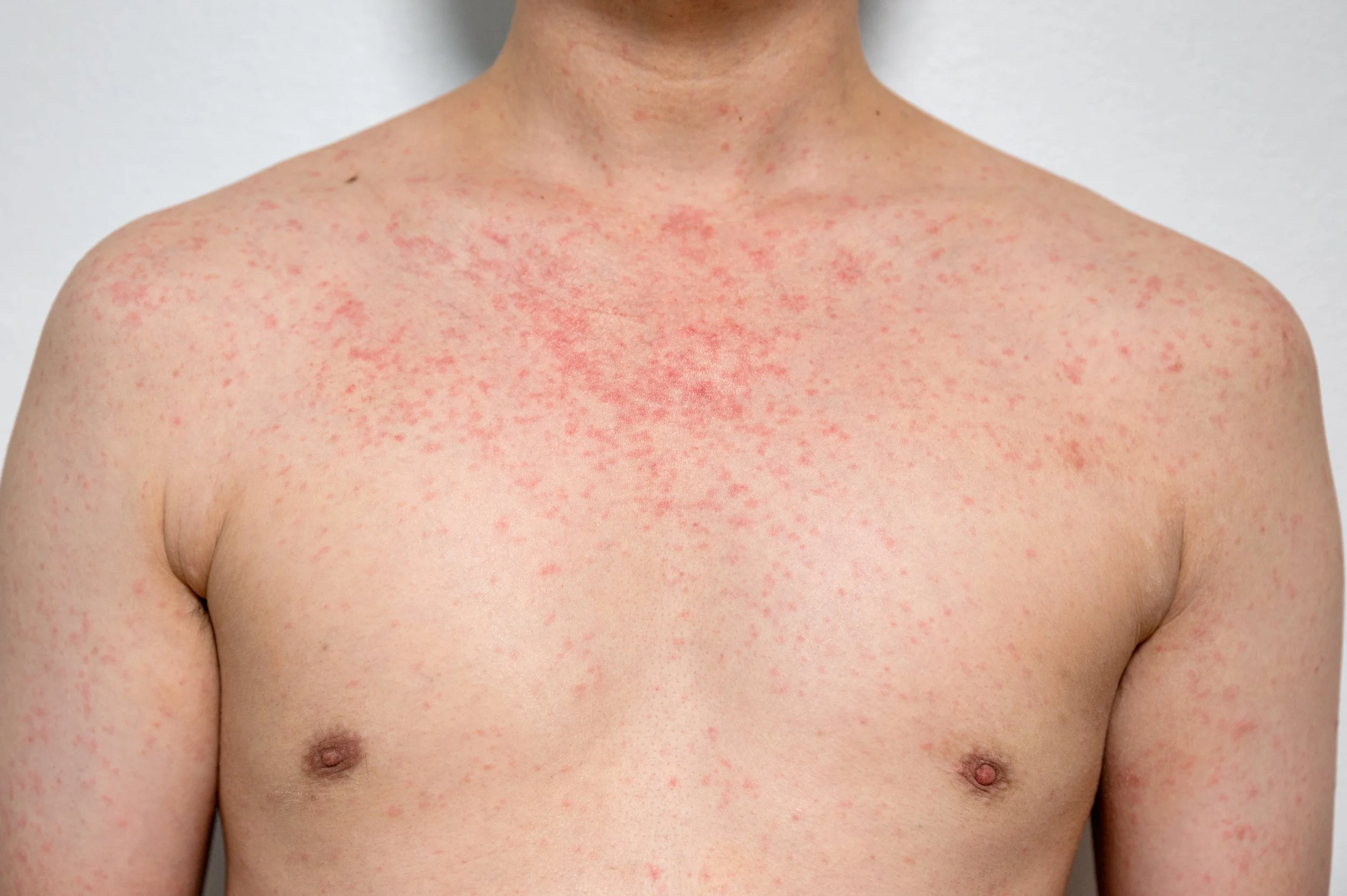 Roseola Infantum (ไข้หัดกุหลาบ)