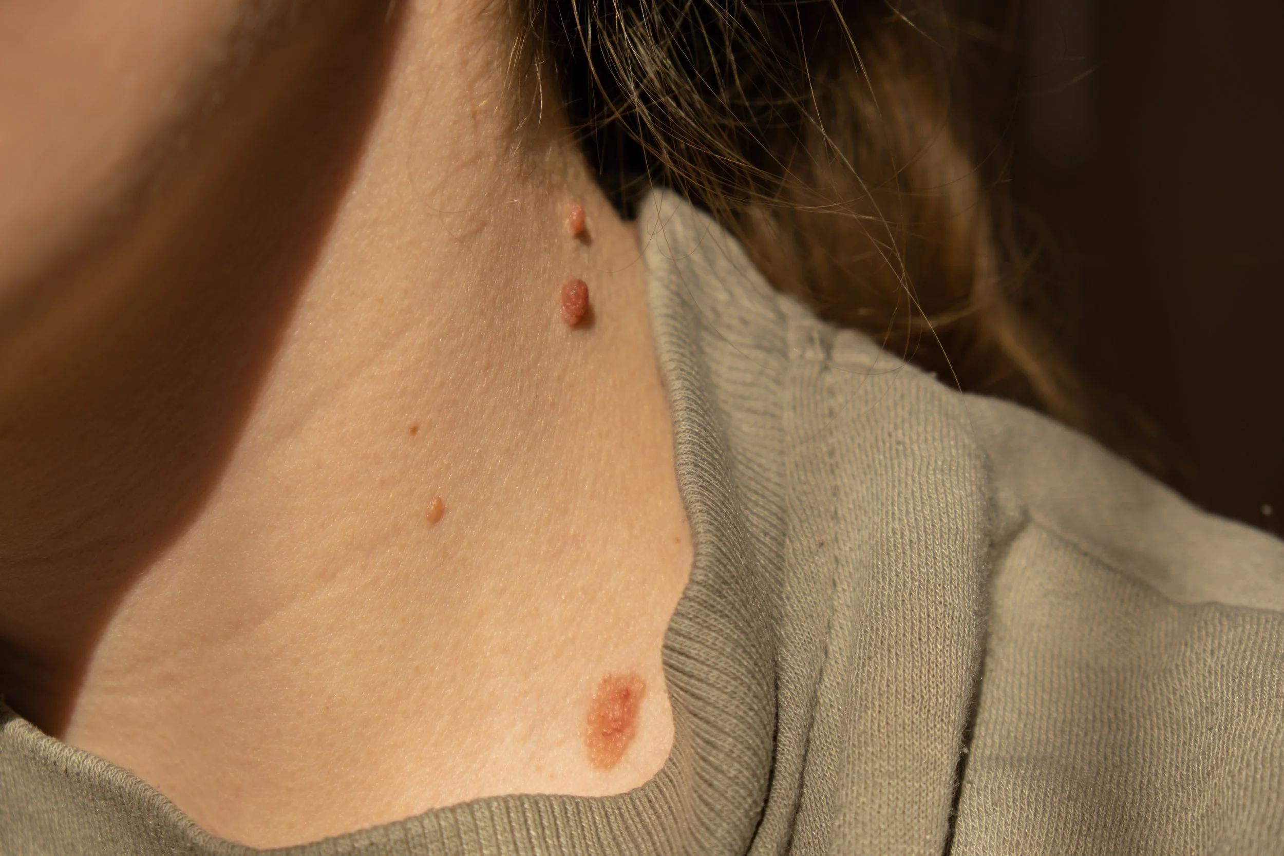 Wart(หูด)