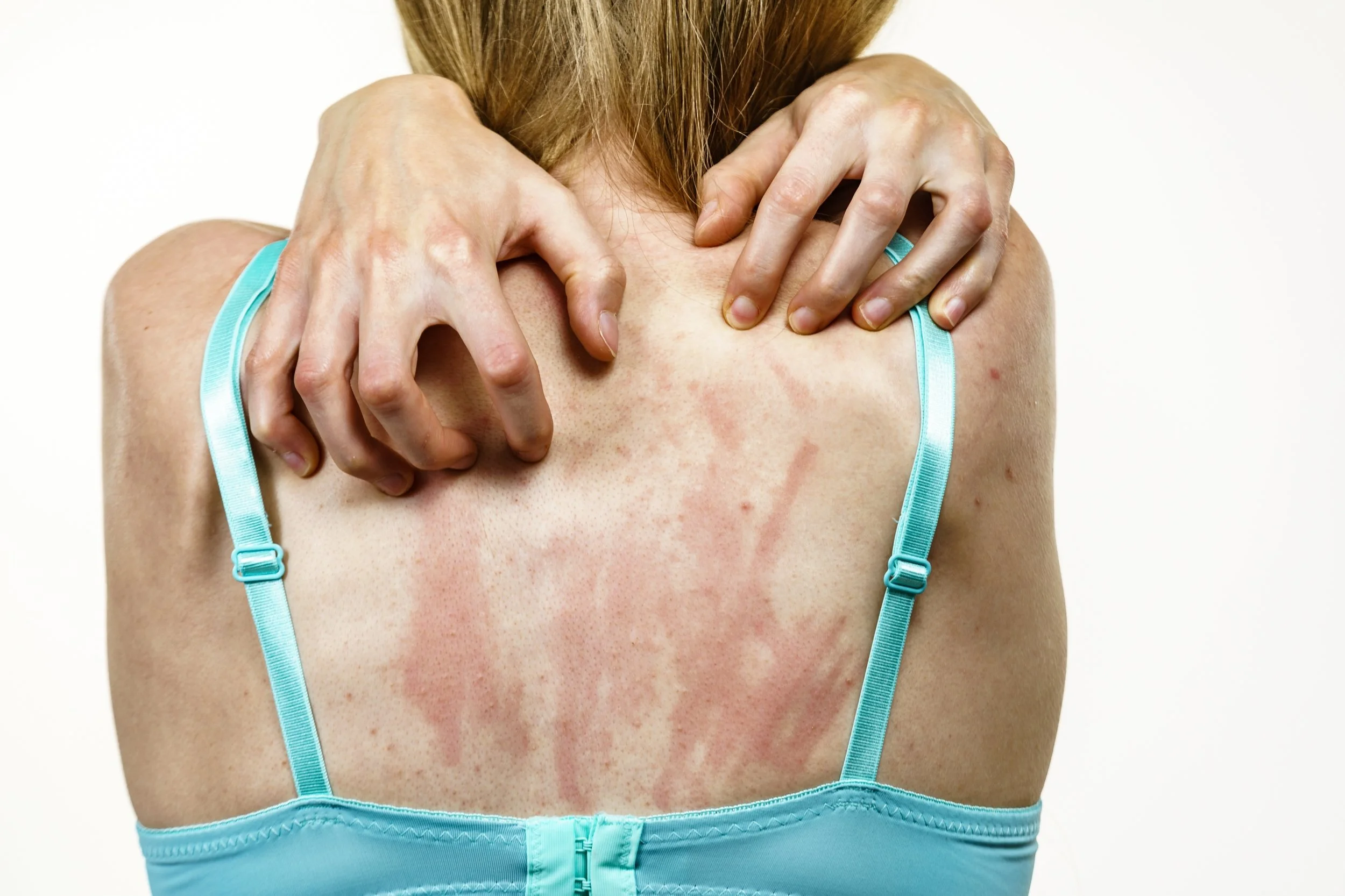 Dermatophytosis (กลาก)
