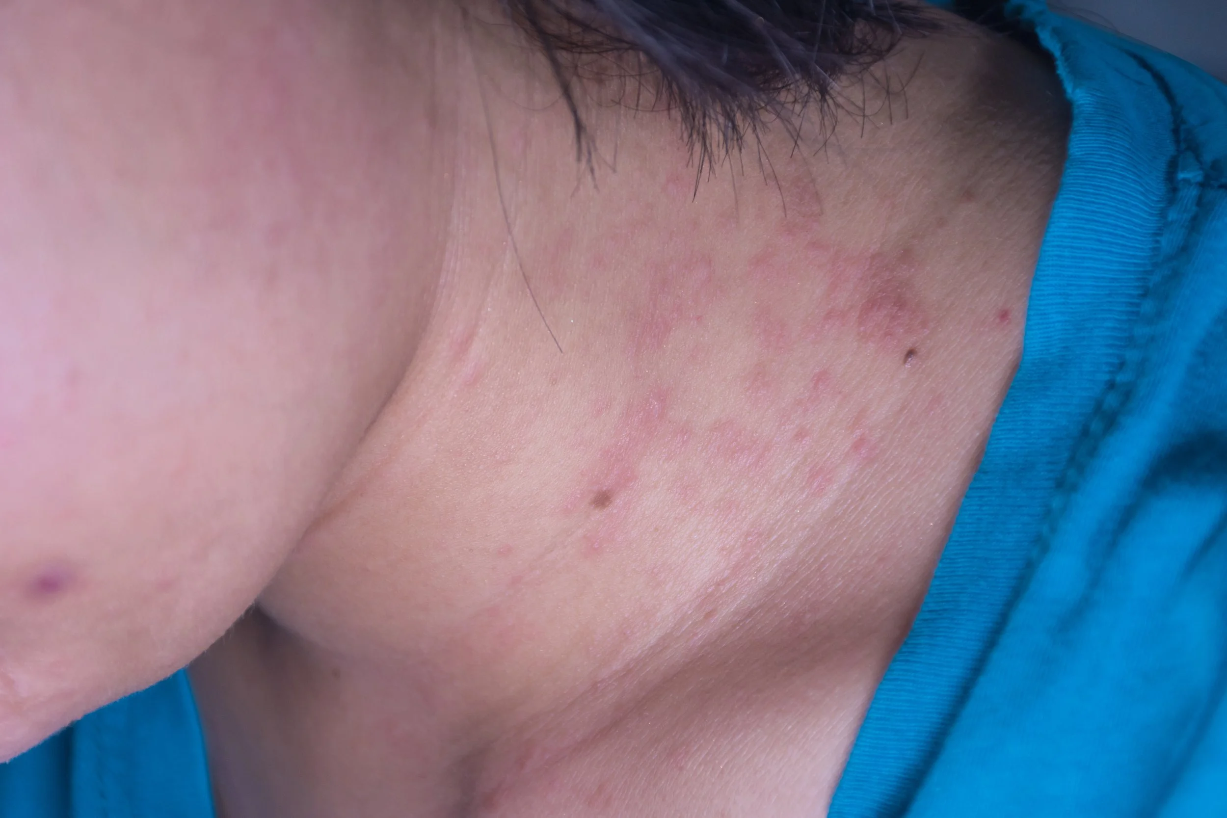 Candidiasis(ยีสต์)