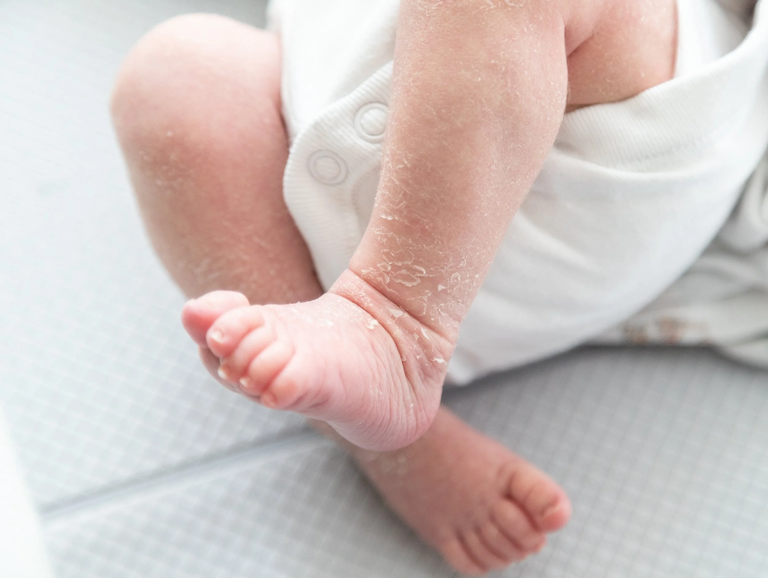 Lamellar Ichthyosis(เด็กดักแด้)