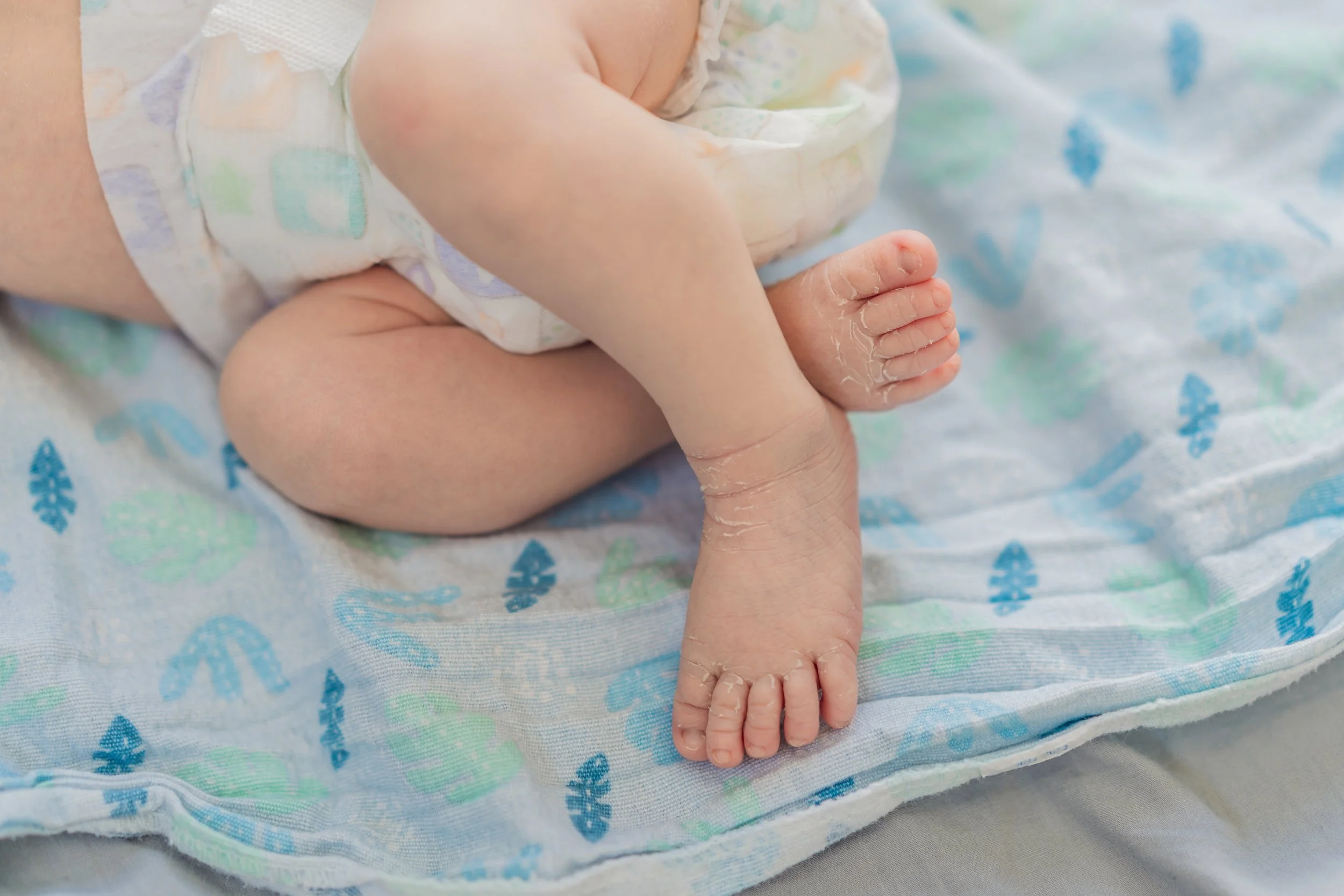 Lamellar Ichthyosis(เด็กดักแด้)