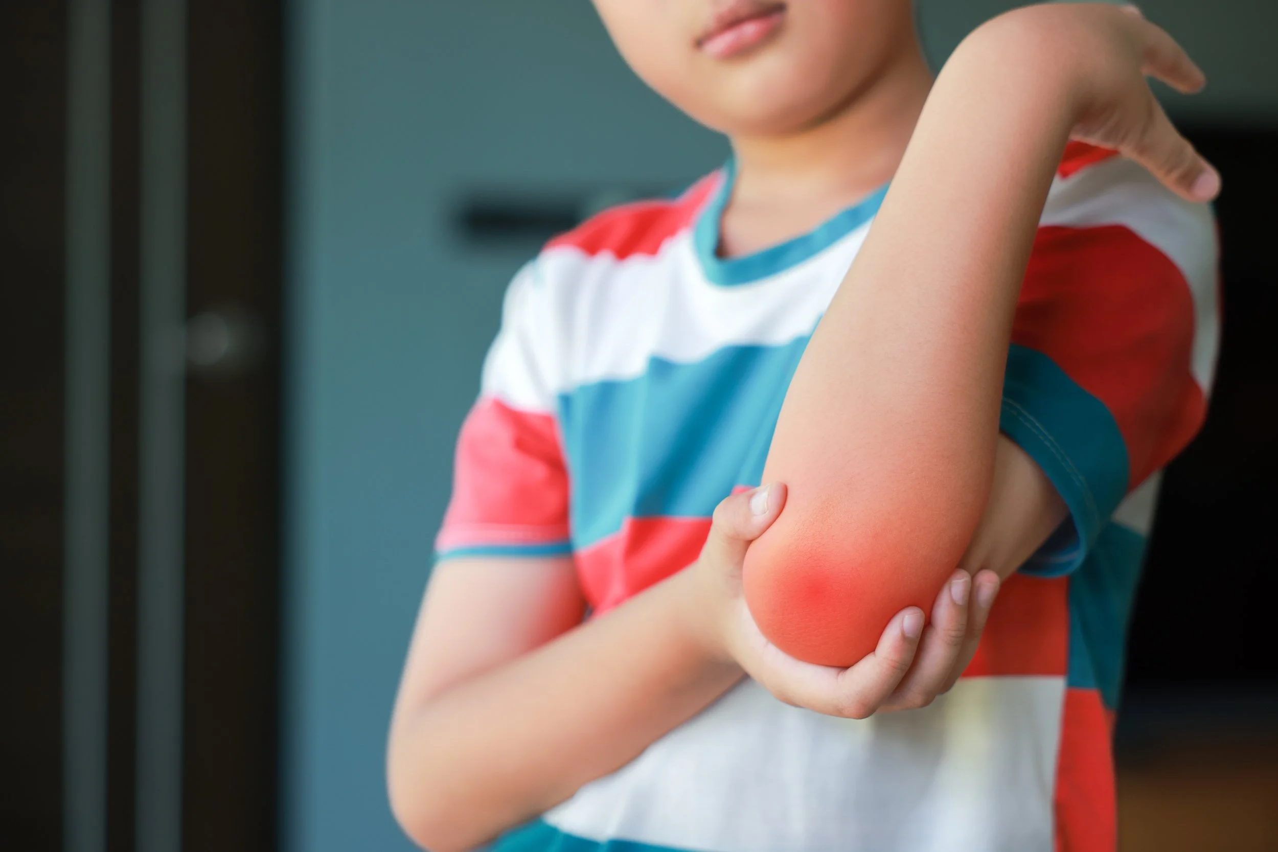 Juvenile Dermatomyositis (โรคผิวหนัง และกล้ามเนื้ออักเสบในเด็ก)