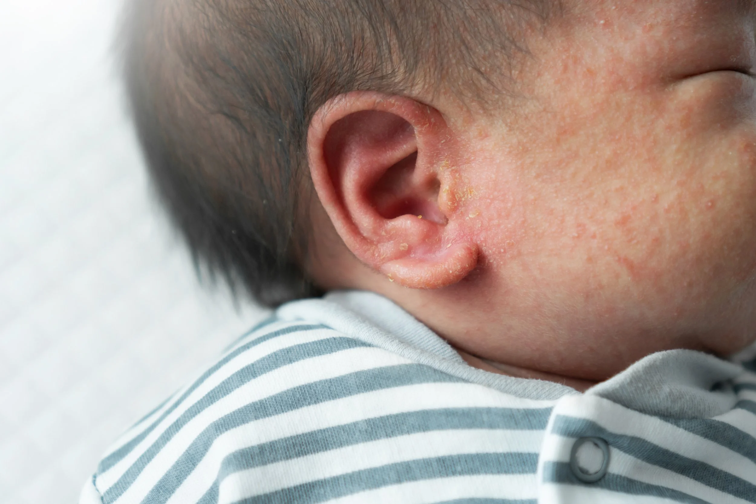 Neonatal Lupus Erythematosus (NLE) (โรคลูปัสในทารกแรกเกิด)