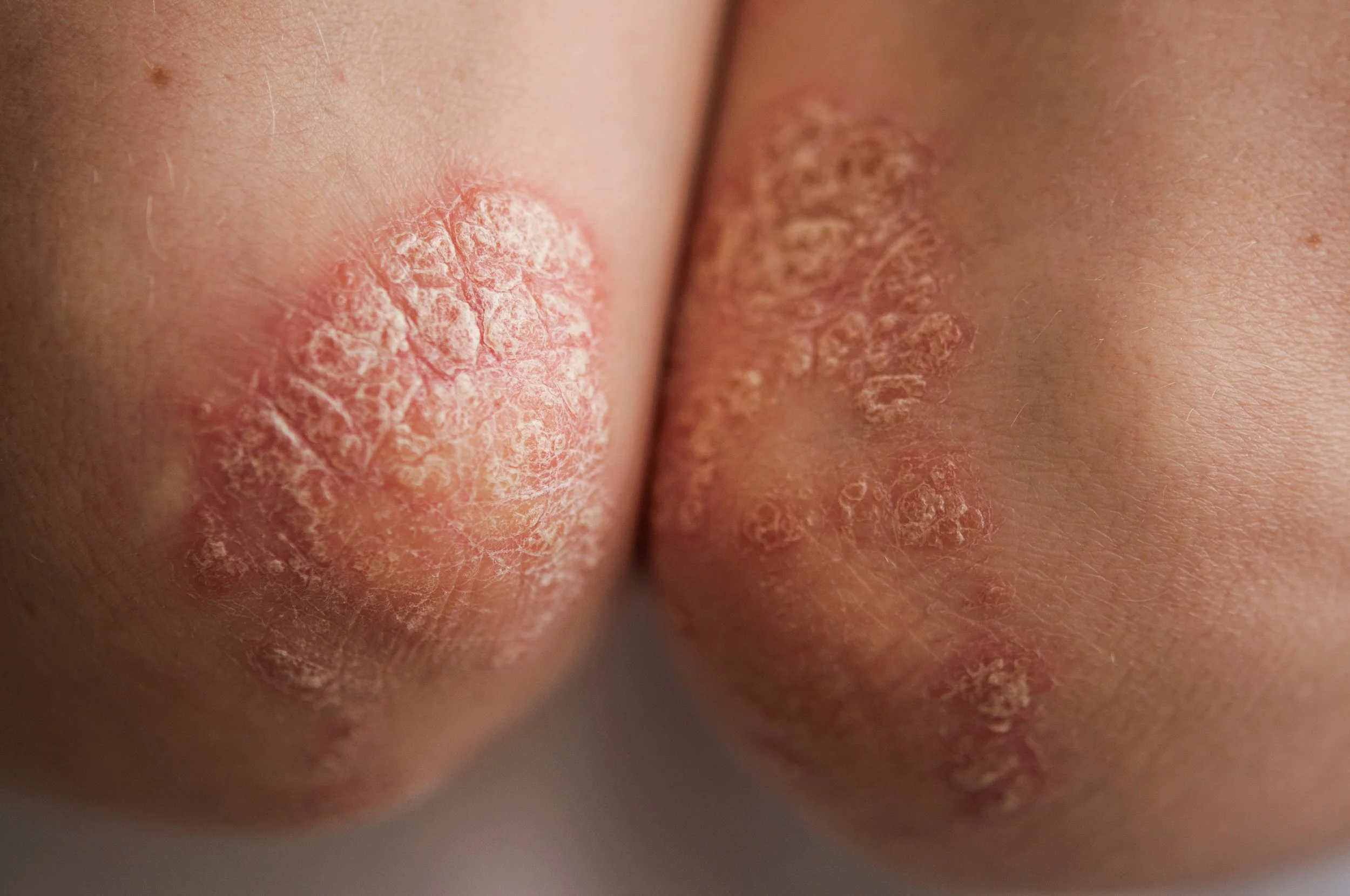 Psoriasis(โรคสะเก็ดเงิน)