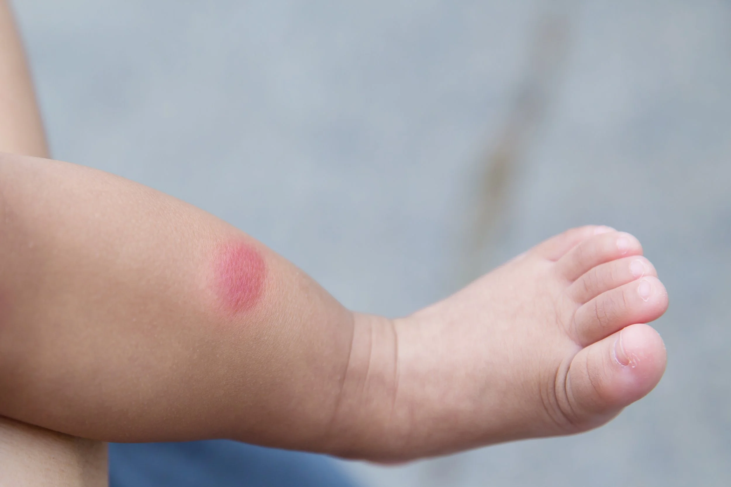 Hemangioma(เนื้องอกของเส้นเลือด)