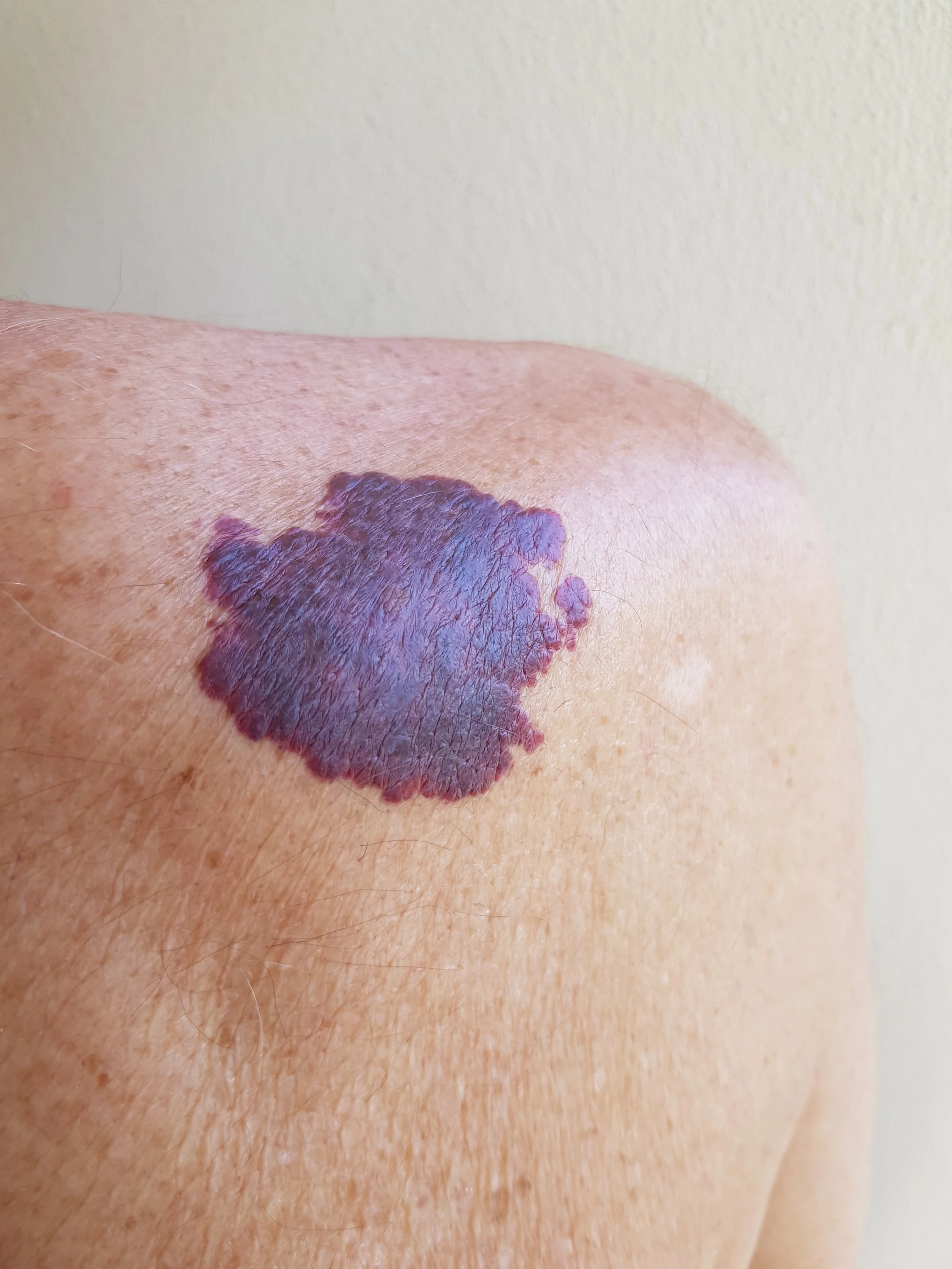 Port-Wine Stains(ปานแดง)