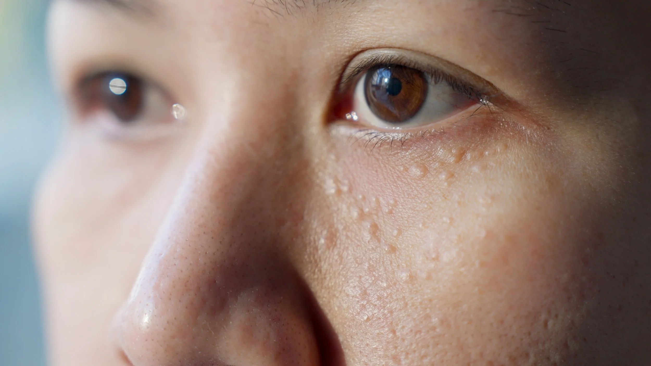 Seborrheic Keratosis(กระเนื้อ)