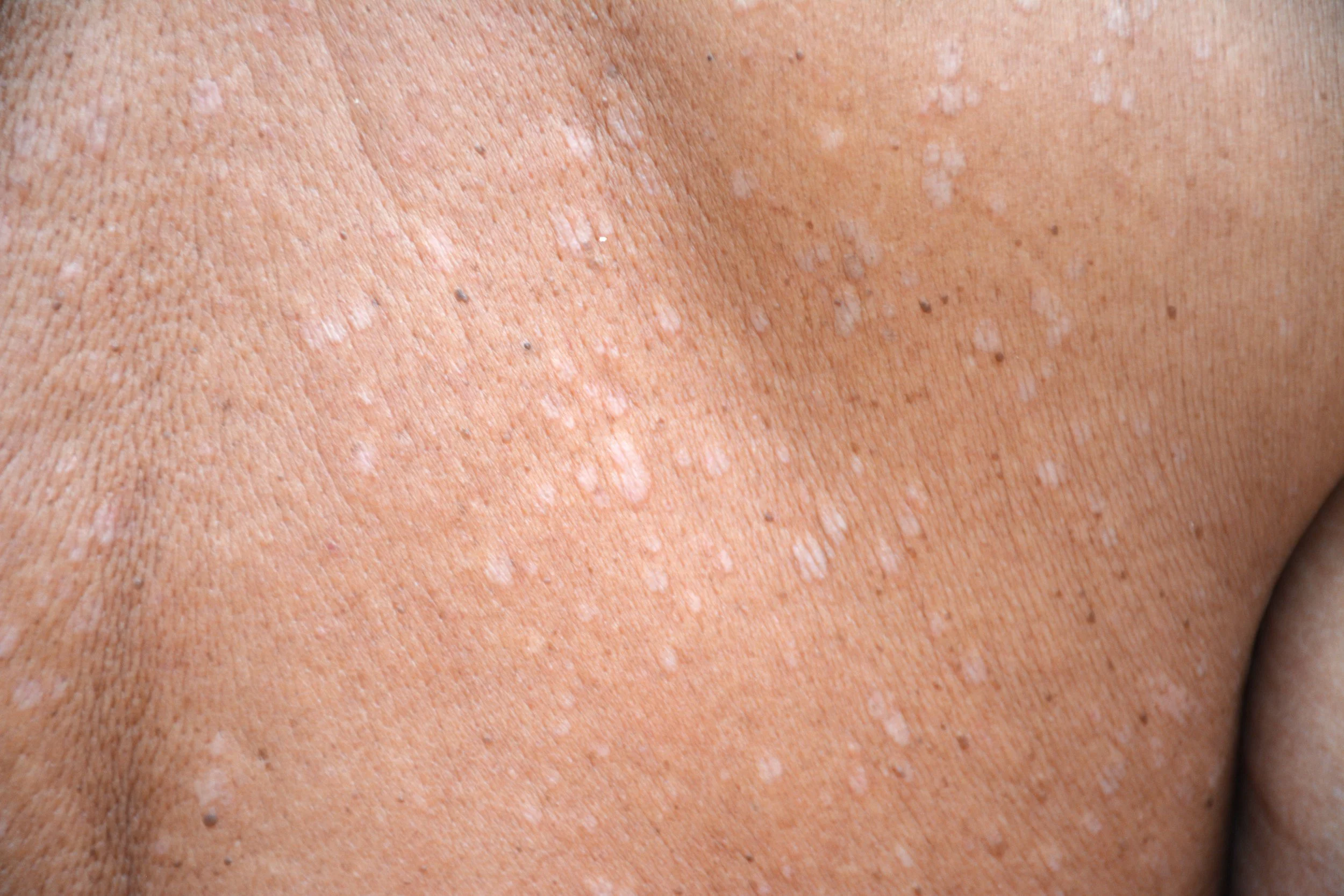 Pityriasis Versicolor(เกลื้อน)