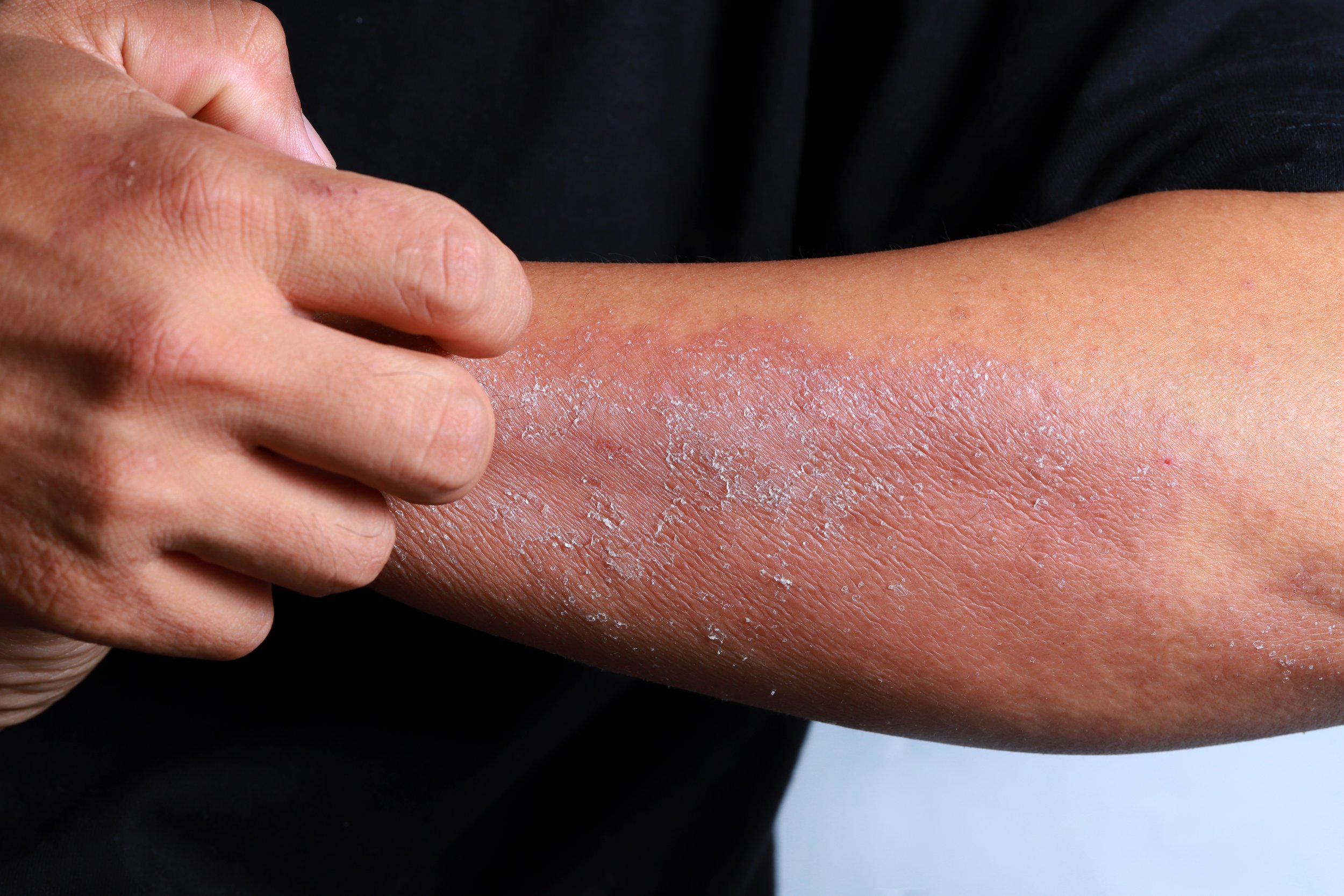 Eczema หรือ Dermatitis