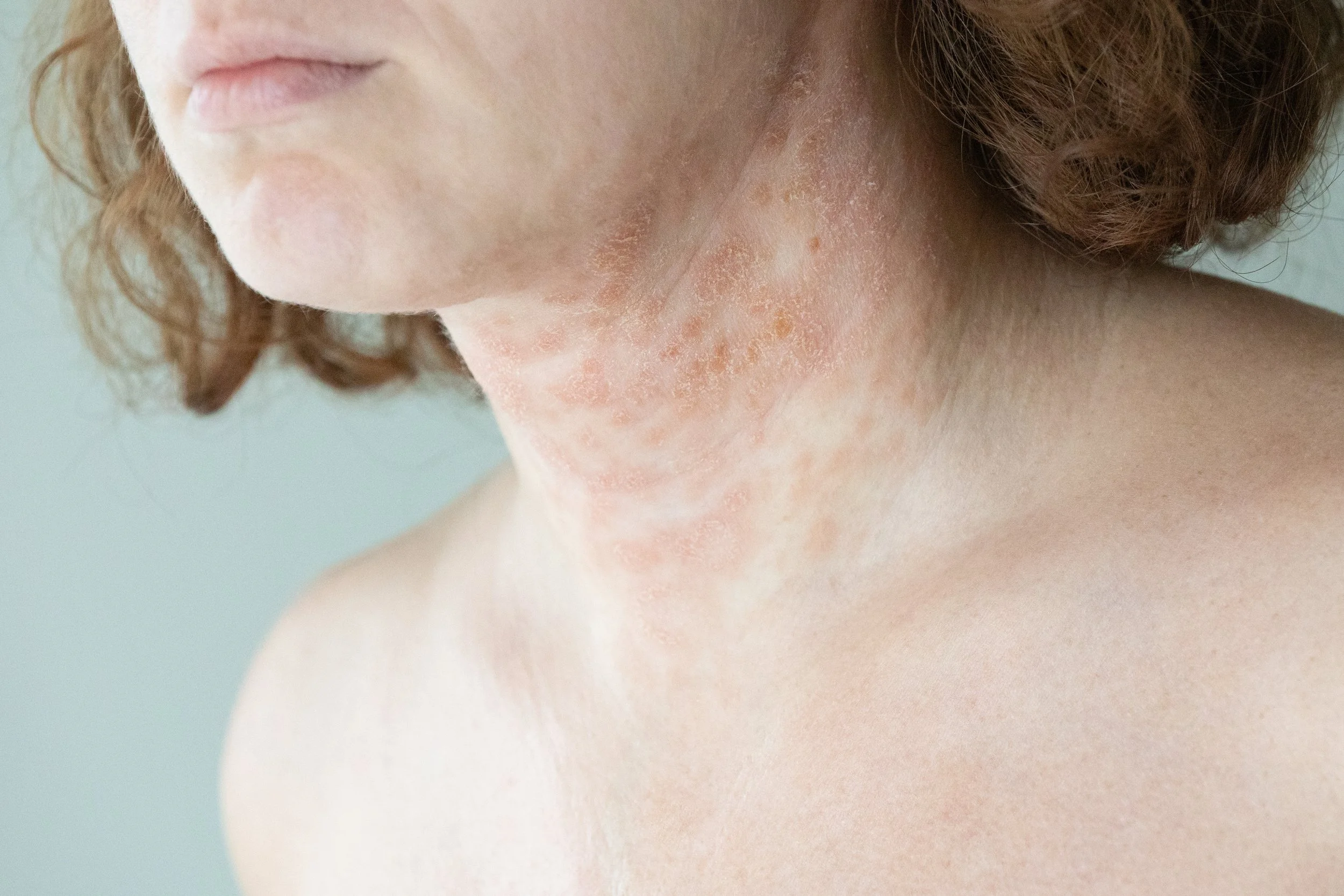 Atopic Dermatitis(ผื่นภูมิแพ้ผิวหนัง)