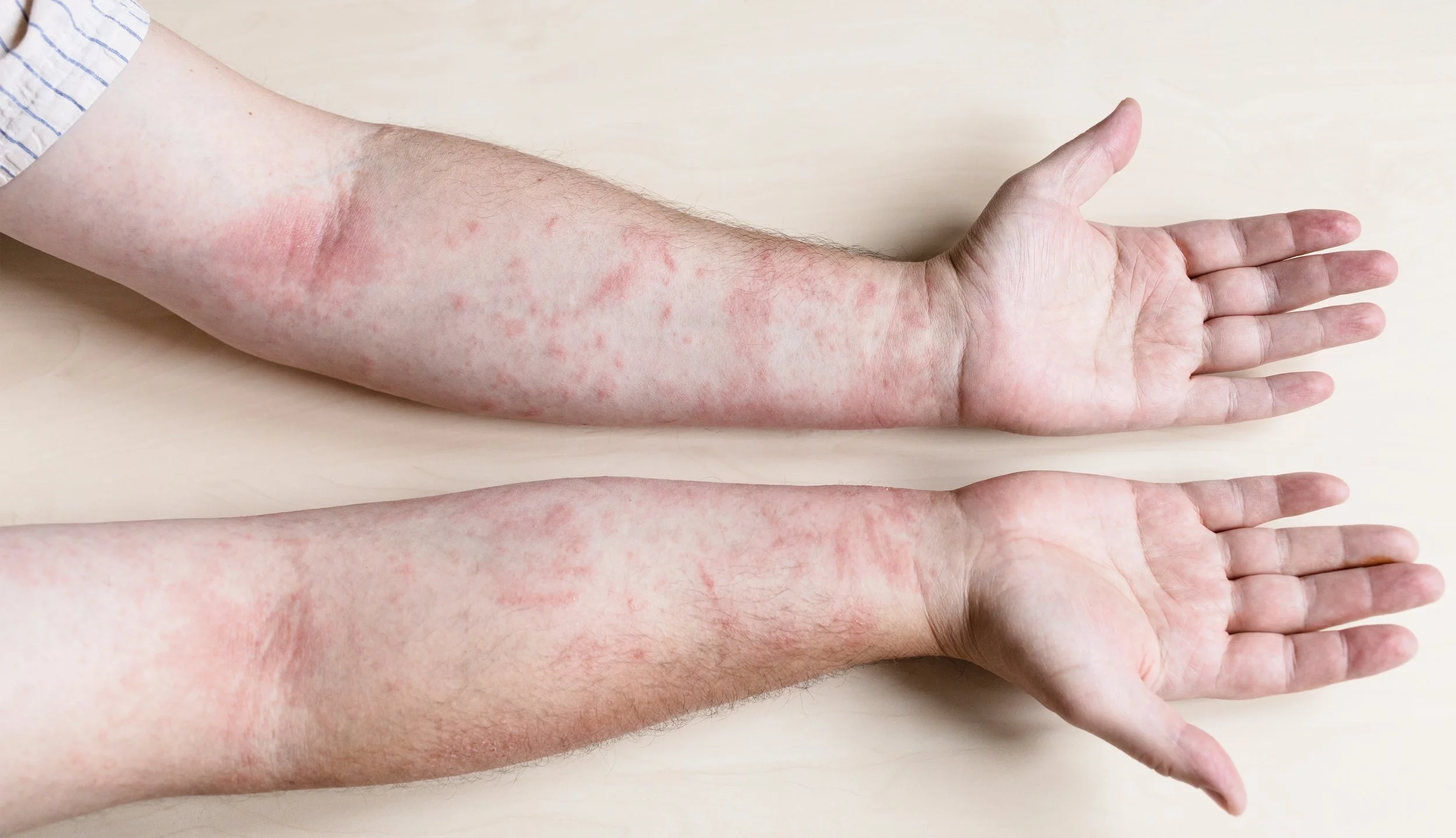 Contact Dermatitis (ผื่นแพ้สัมผัส)