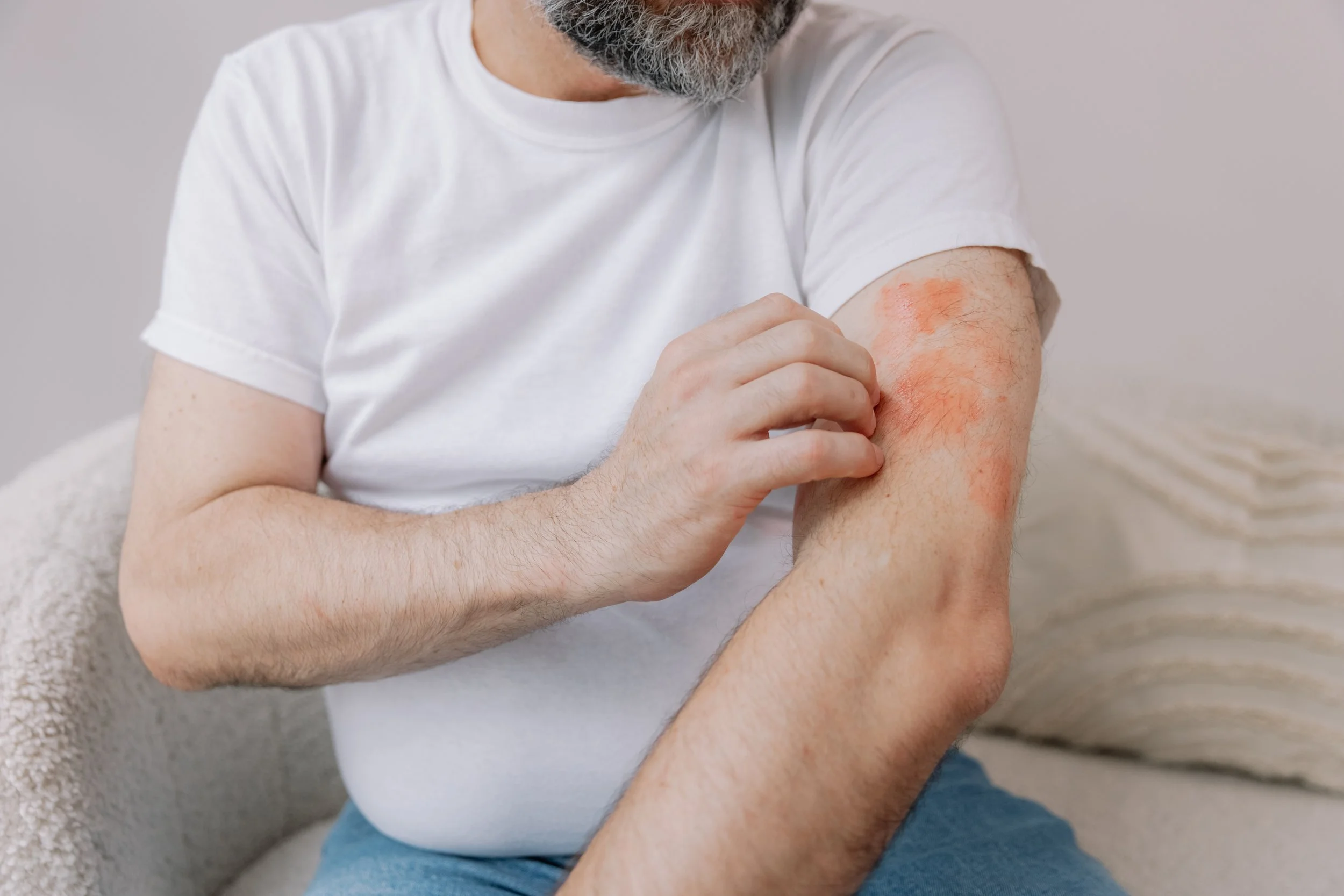 Nummular Dermatitis (ผื่นผิวหนังอักเสบ)