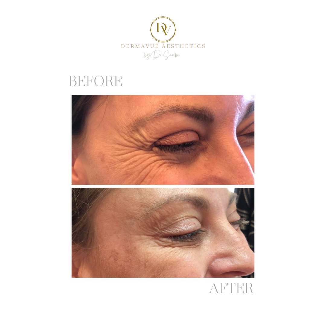 Crows feet lines — Dermavue Aesthetics