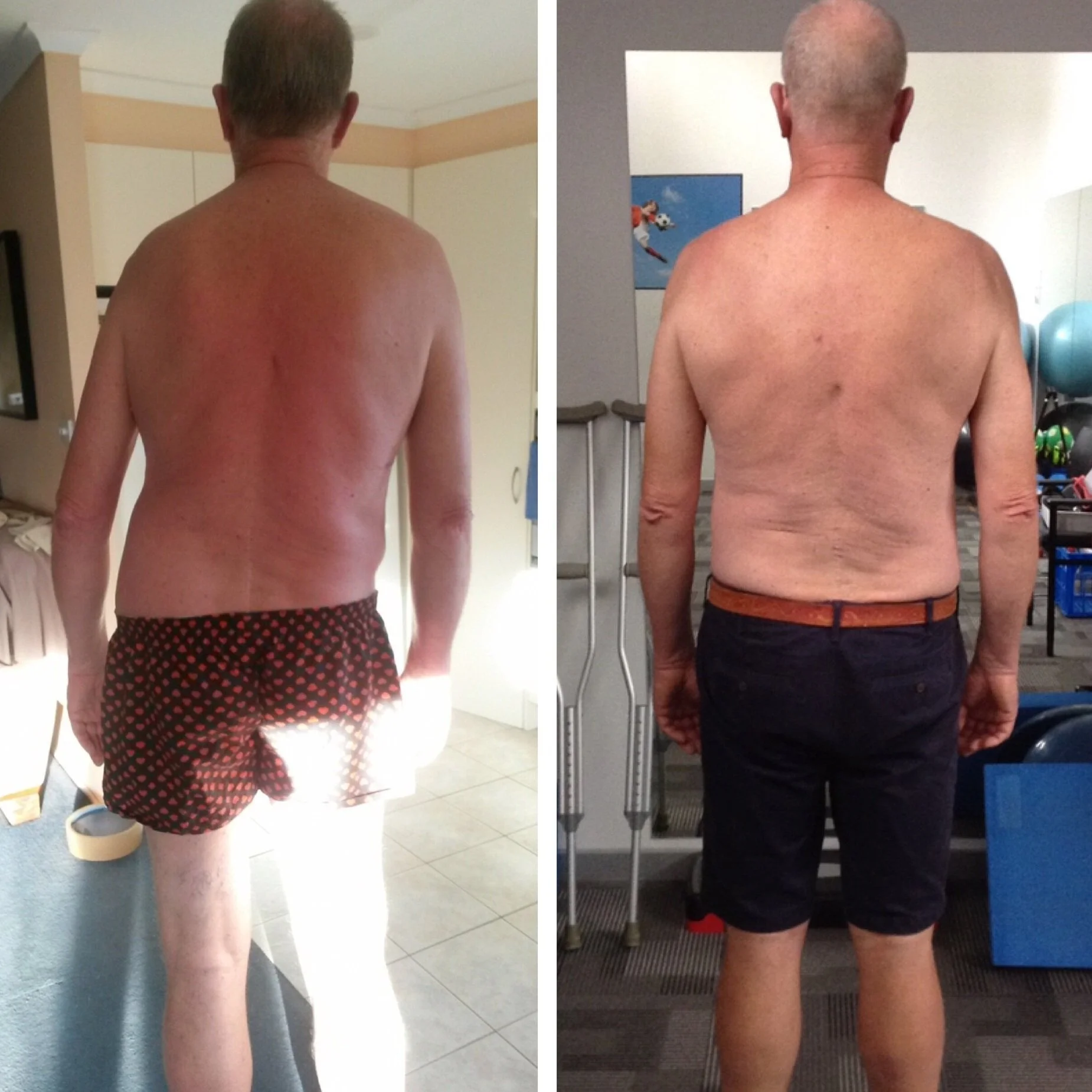 Before and after of disc related back pain client and his results at Functional Patterns Sunshine Coast for back pain treatment