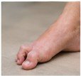 Close-up of a foot with a bunion on the big toe