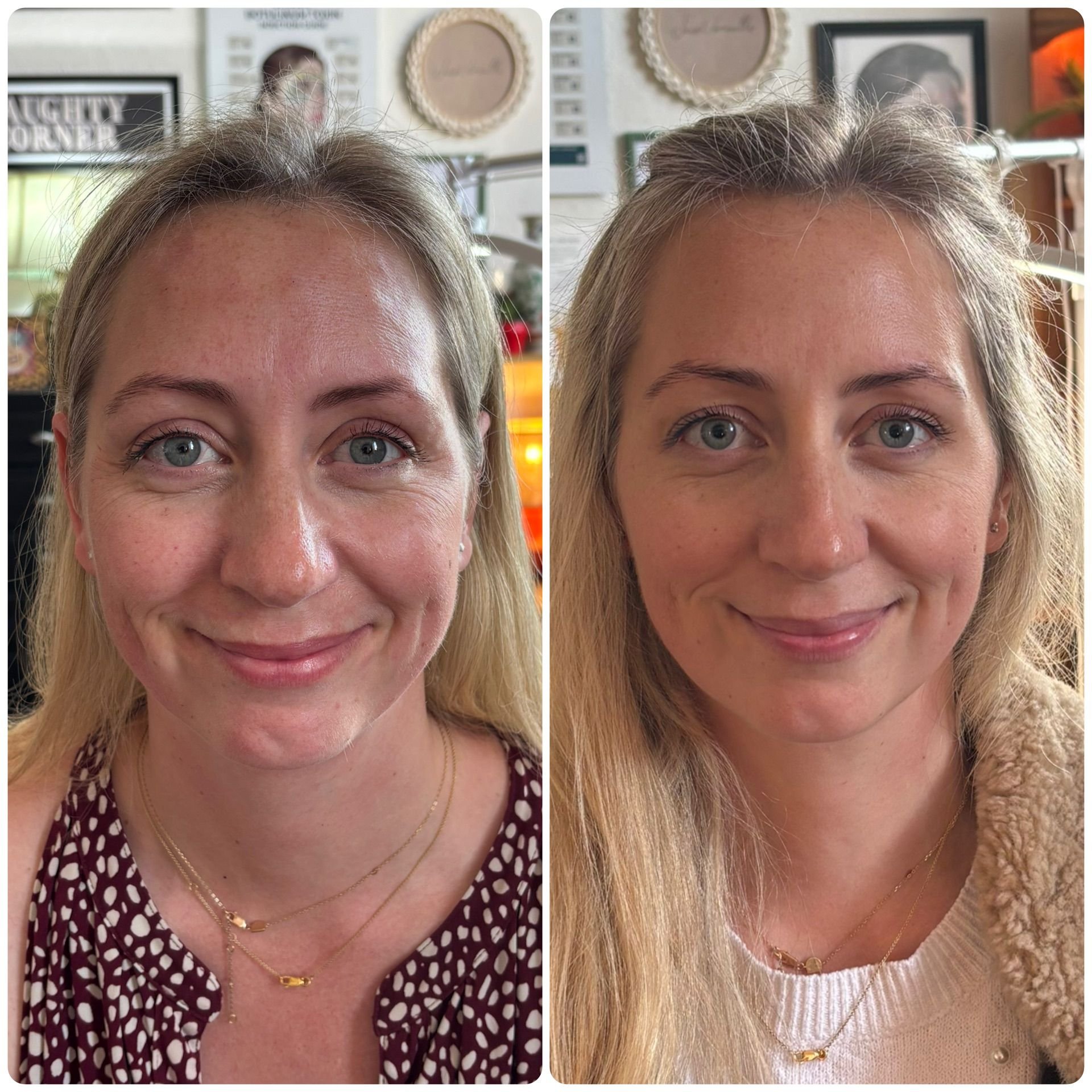 aesthetics clinic cheltenham, lip fillers cheltenham, aesthetics clinic cheltenham