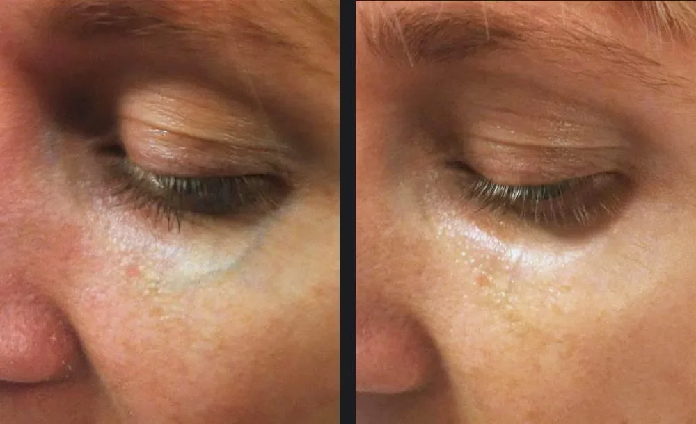 Chemical peel before and after