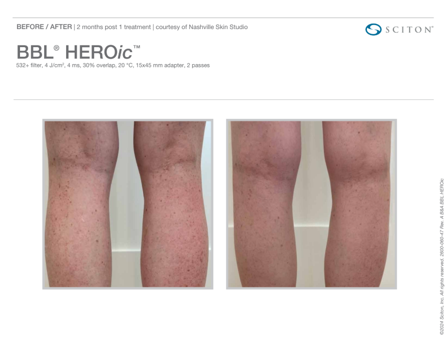 Leg Pigmentation removal