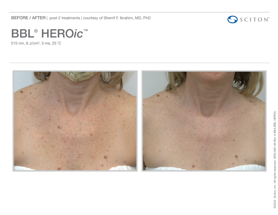 BBL Heroic Pigmentation before and after chest 