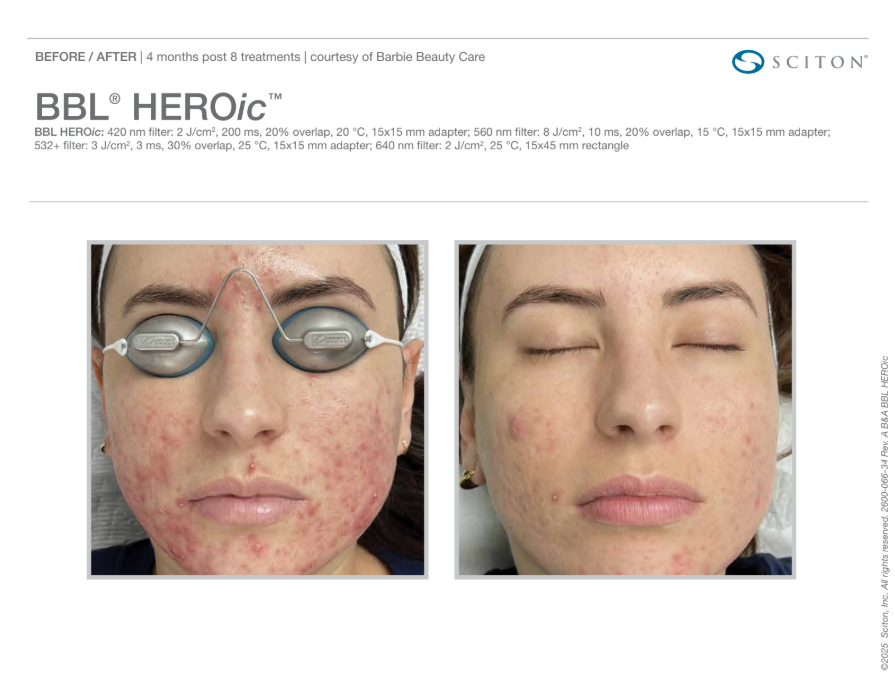 BBL Forever Clear Acne treatment