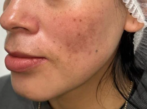 Why Do Dark Marks Keep Coming Back?