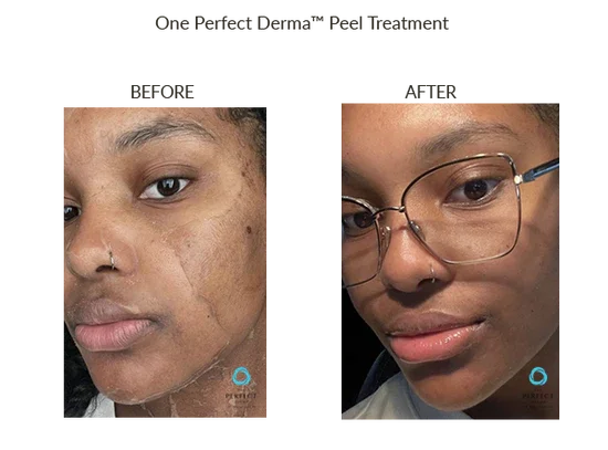 Before and after cosmelan peel