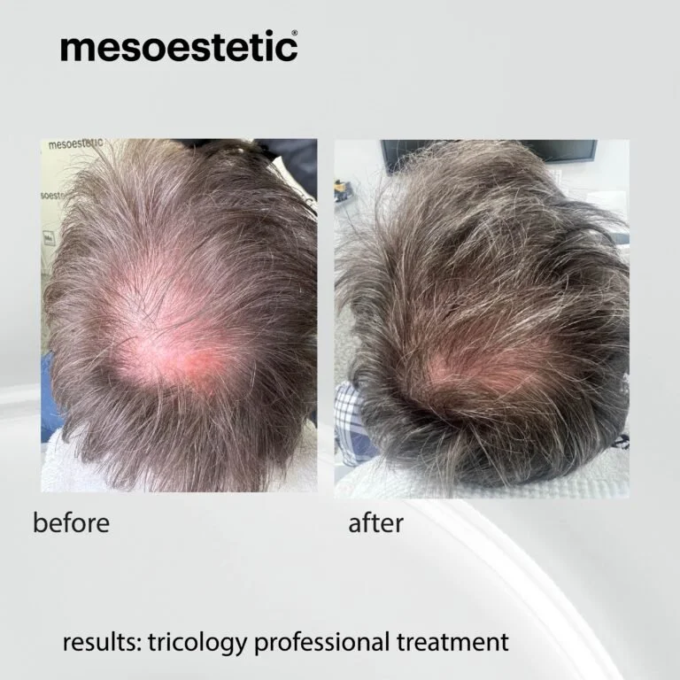 hairloss exosomes