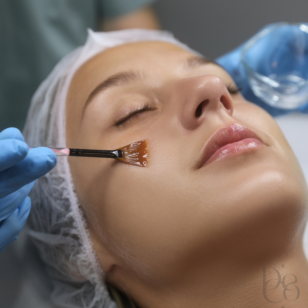 Chemical peels in london bridhe