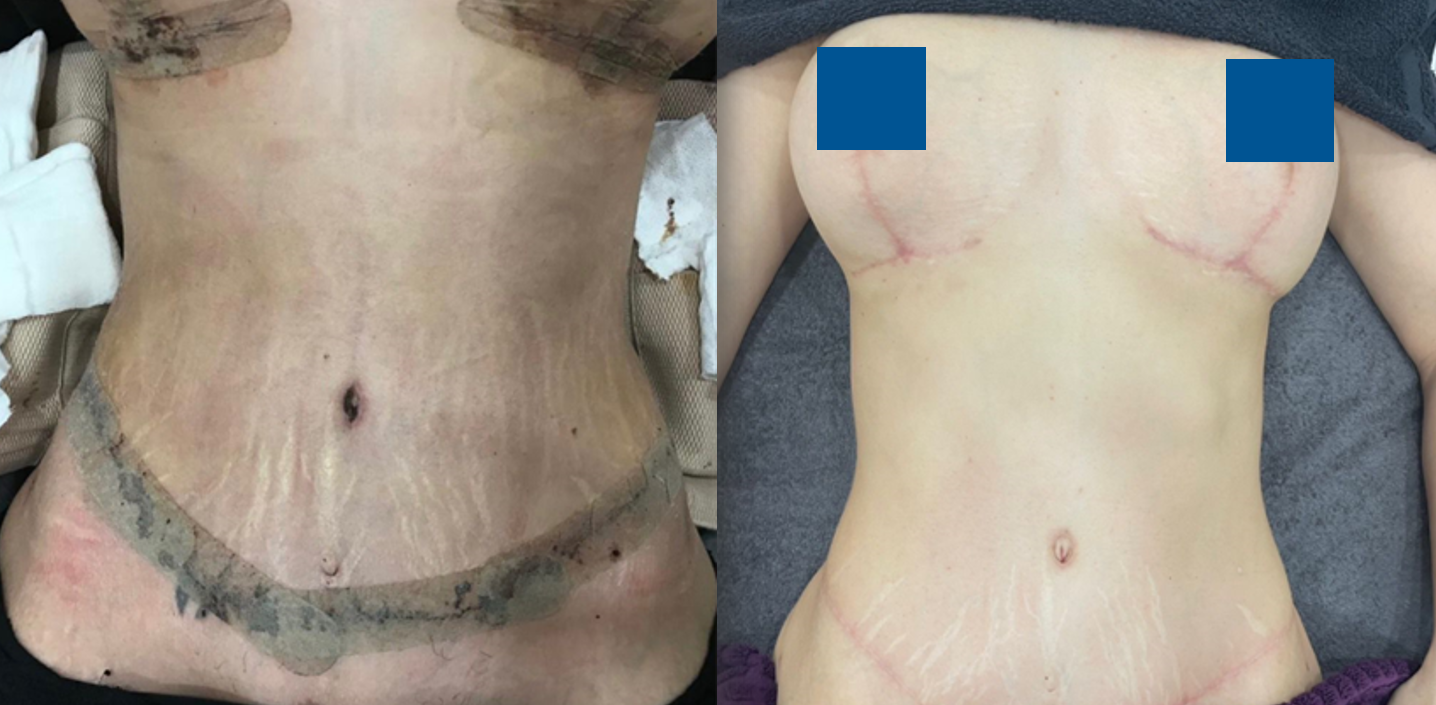 Tummy tuck healing with LED light therapy