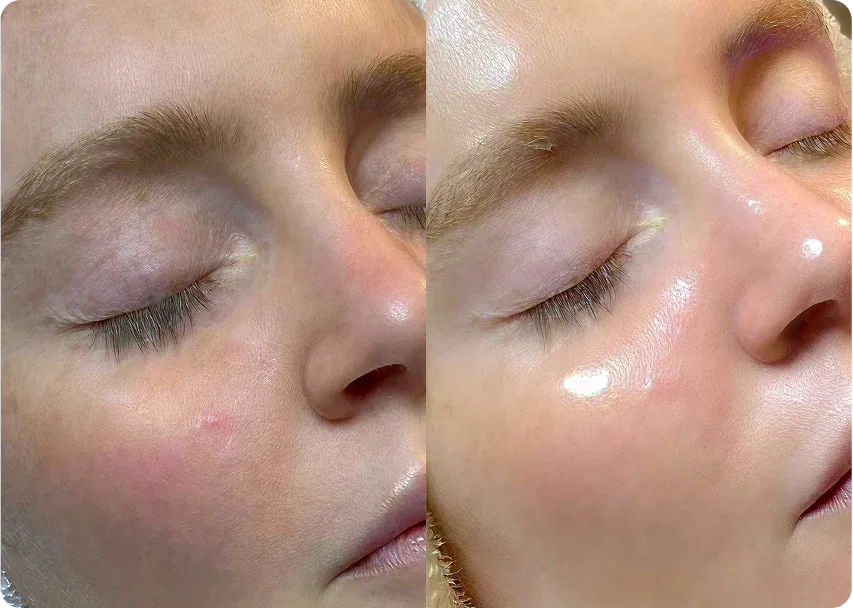 Glowing skin facial