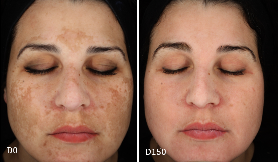 Before and after cosmelan peel
