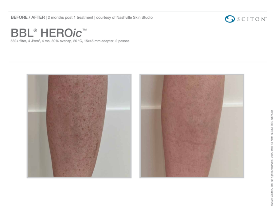 BBL Heroic Pigmentation before and after legs