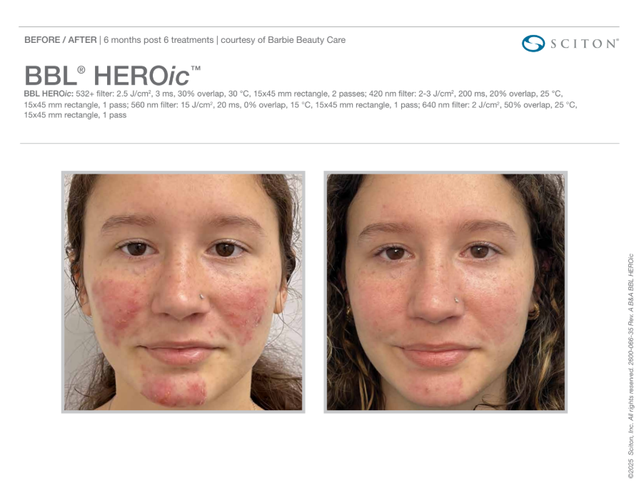 BBL Heroic before and after acne