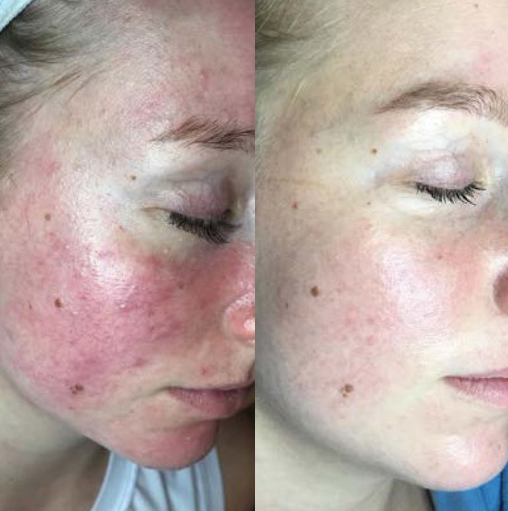 Post treatment LED light therapy