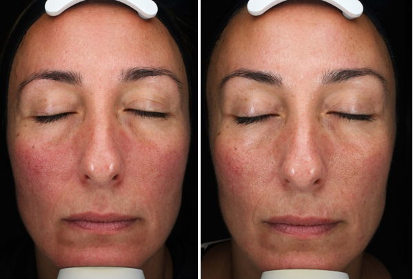 Chemical peel before and after