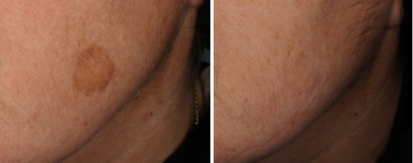 Chemical peel before and after