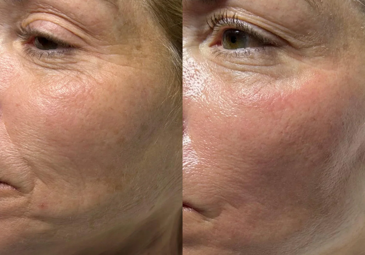 Hydrafacial London bridge