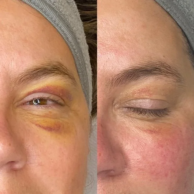 LED light therapy for bruising