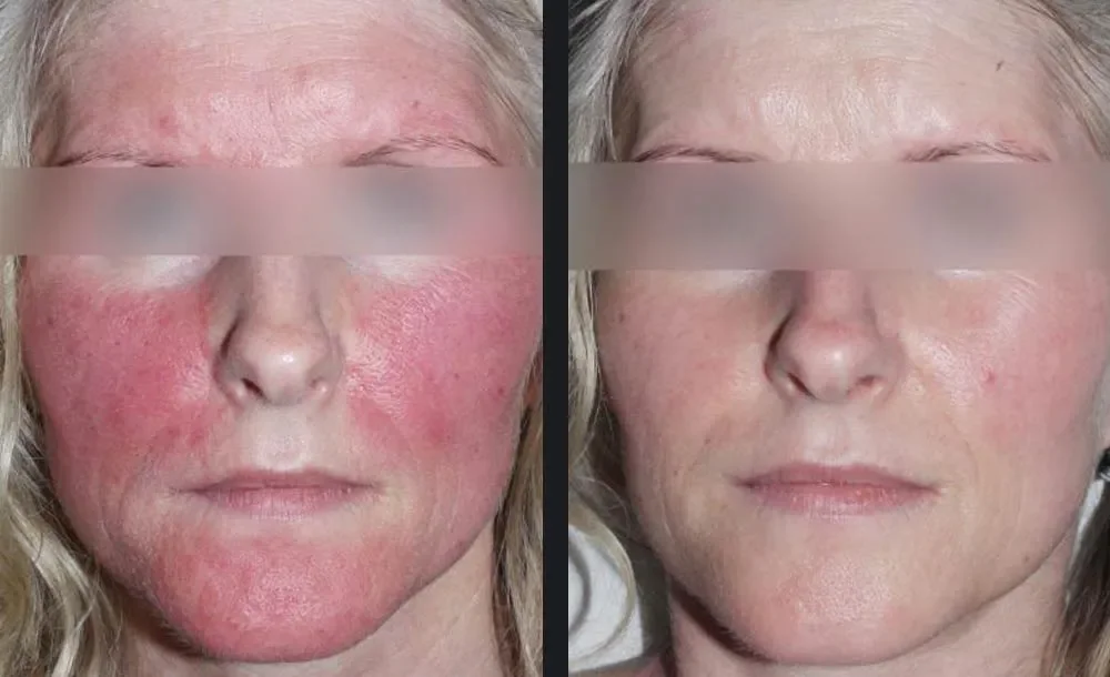 Chemical peel before and after