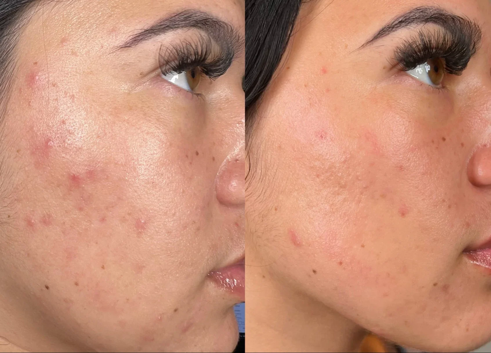 Facial for acne skin